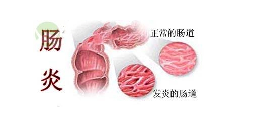 直肠炎患者日常饮食方面需要注意的事项，你知道多少？